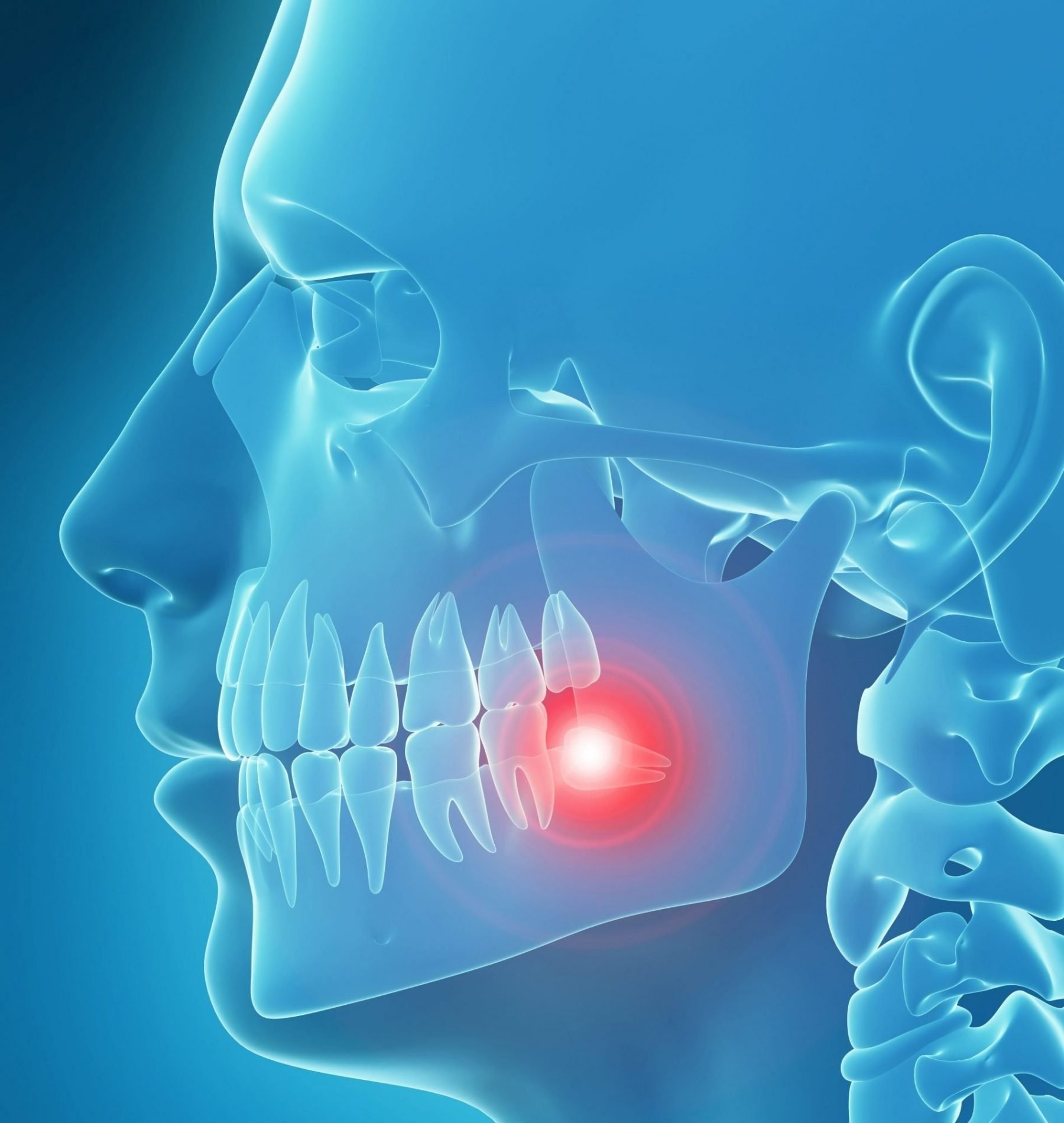 After Exposure of an Impacted Tooth