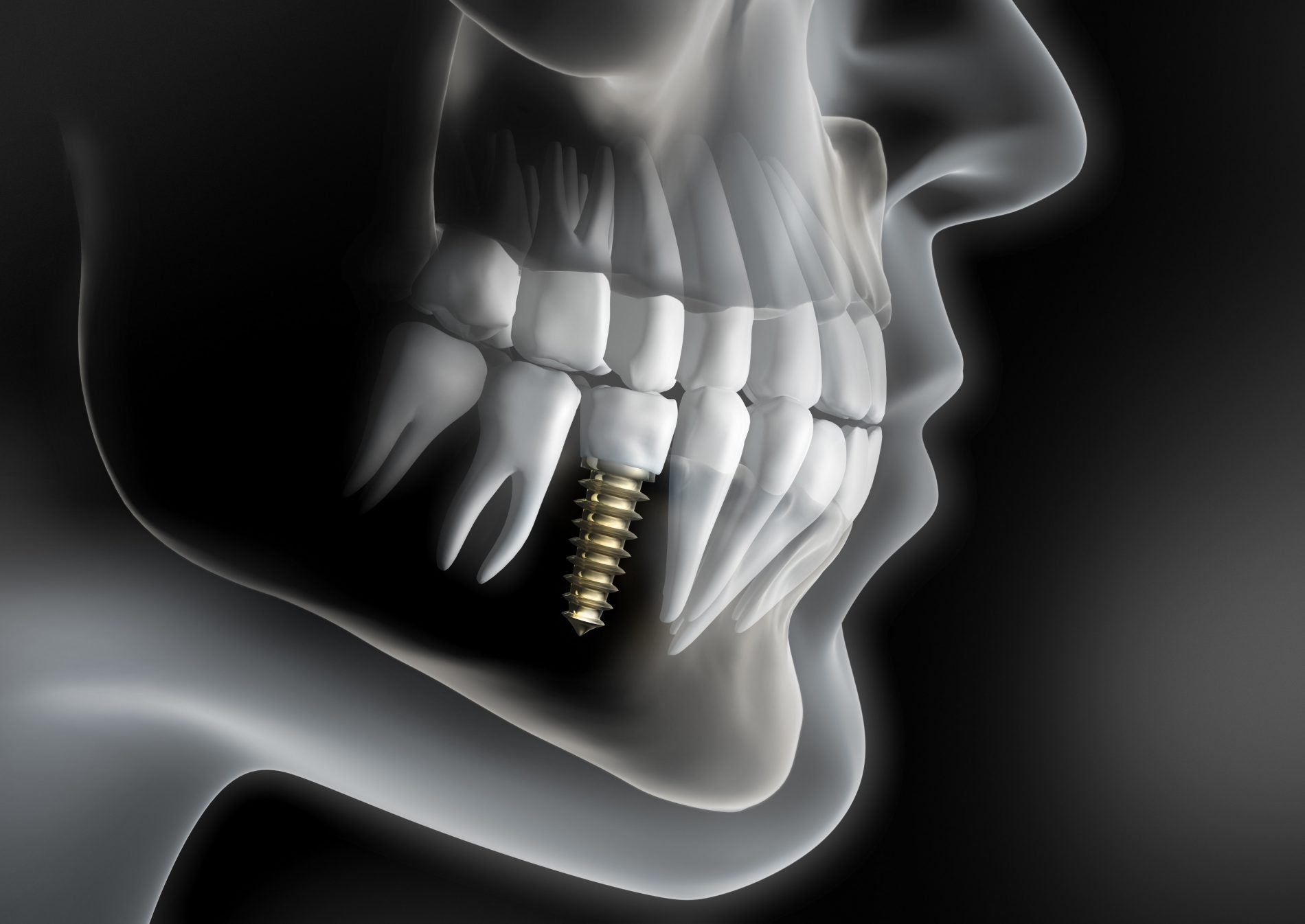 After Placement of Dental Implants
