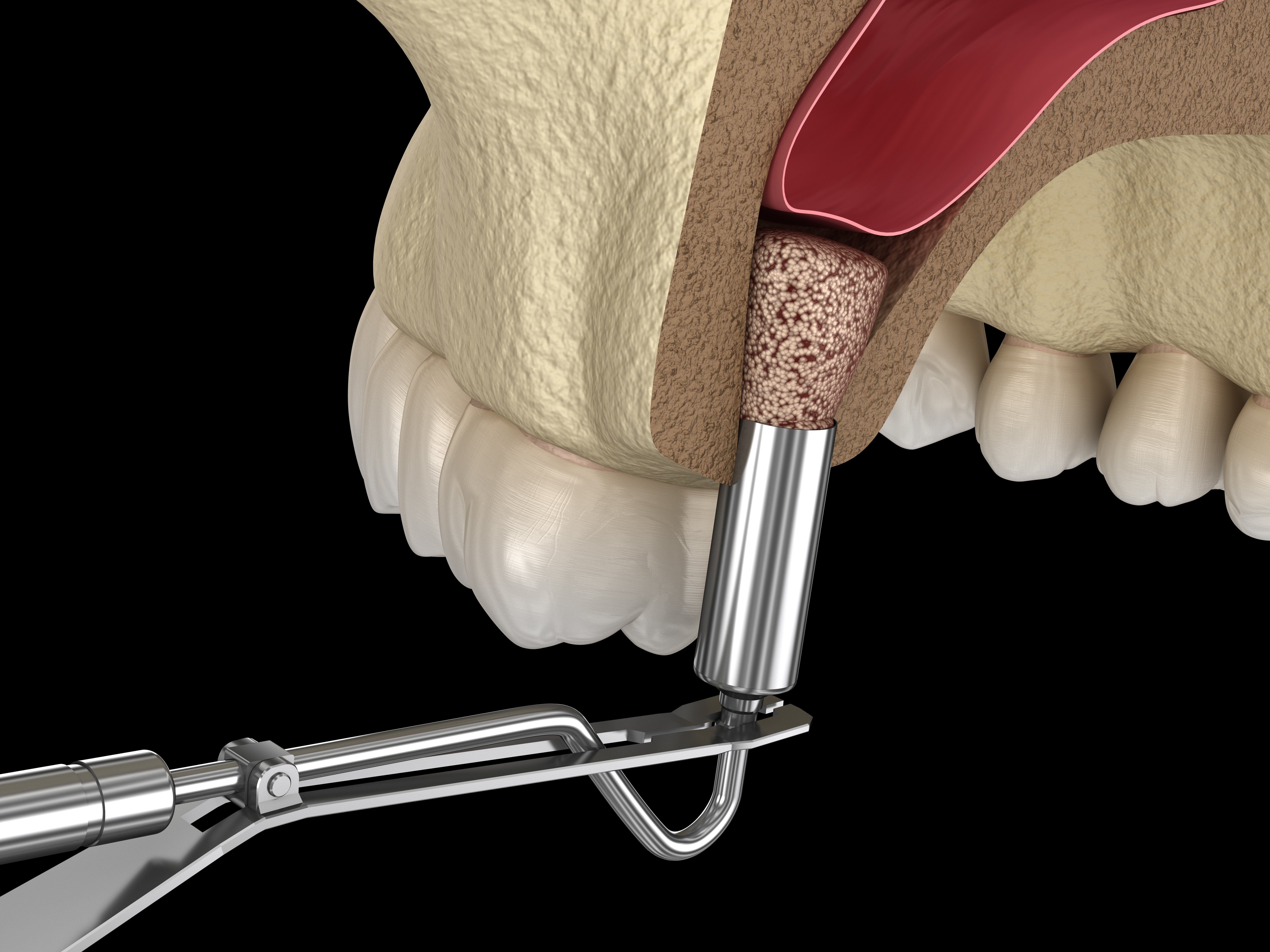 After Sinus Lift