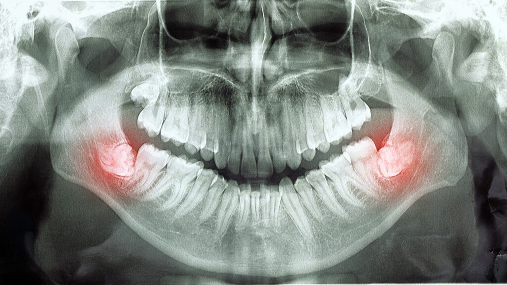 Wisdom Tooth Extractions in Fayetteville, why you may need your wisdom teeth removed
