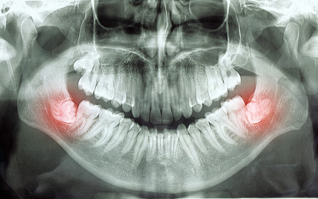 Wisdom Tooth Extractions in Fayetteville