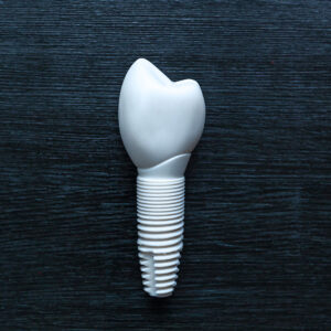 Ceramic Dental Implants