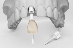 Ceramic Zirconia Implants