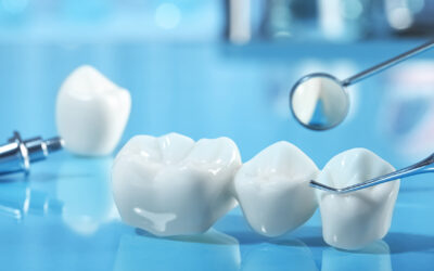 Single Tooth Implant vs Dental Bridge: Choosing What’s Best for You