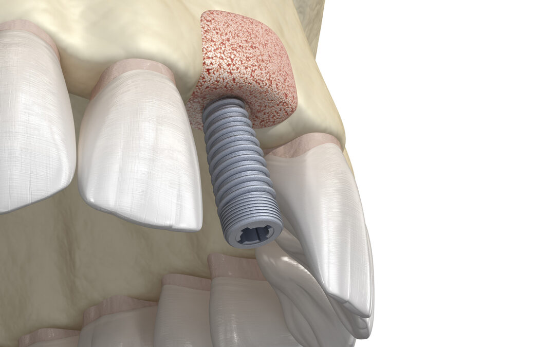Jaw Bone Grafting