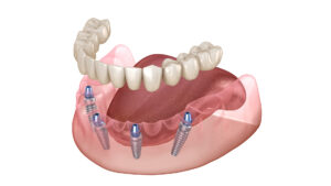 All-On-4 Dental Implants: A Streamlined Path to a Confident, Lasting Smile