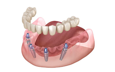 All-On-4 Dental Implants: A Streamlined Path to a Confident, Lasting Smile