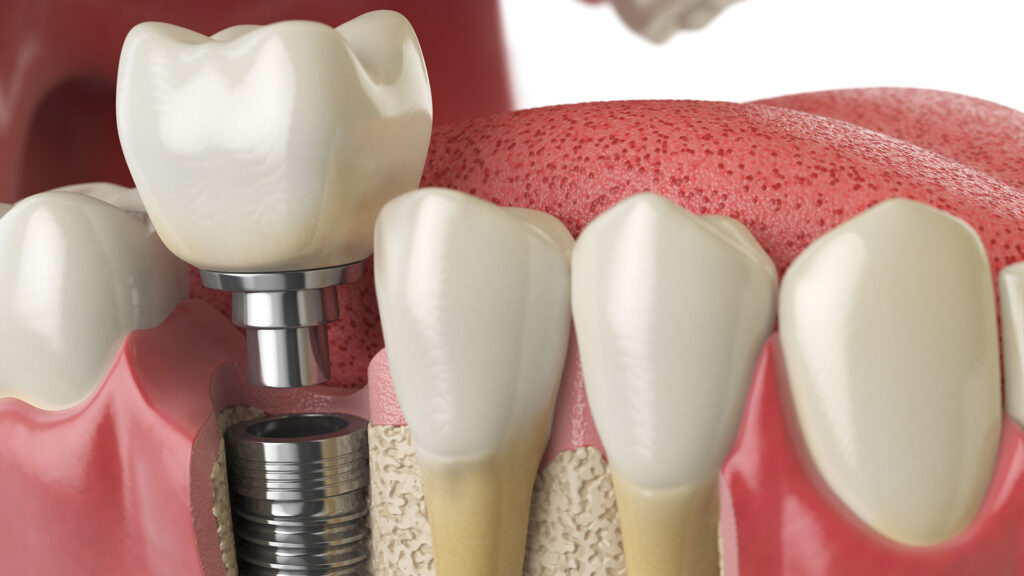 Do Dental Implants Feel Like Real Teeth? What You Need to Know