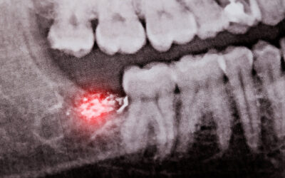 How to Avoid Getting Dry Socket After Wisdom Teeth Removal