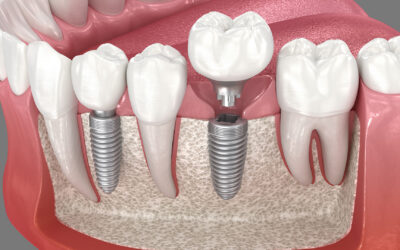 Understanding Success Rates for Dental Implants