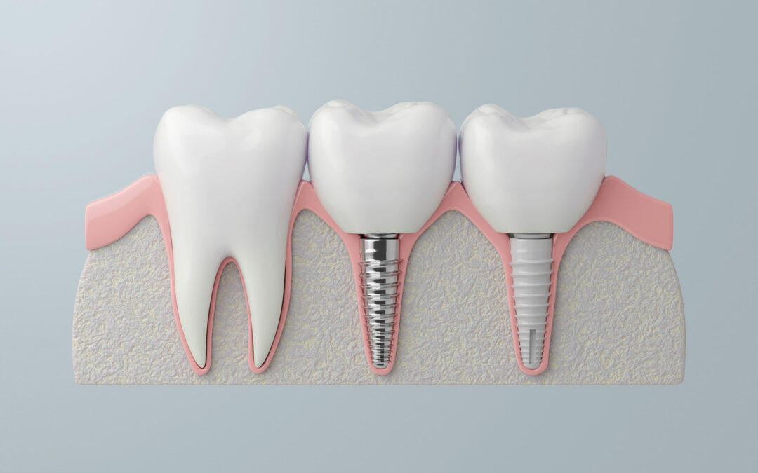 Ceramic vs. Titanium Dental Implants