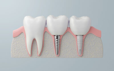 Ceramic vs. Titanium Dental Implants: How to Choose What’s Best for You