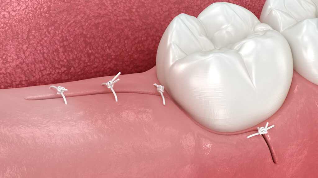 wisdom teeth removal recovery