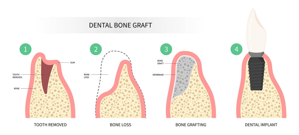 What to Know About Jaw Bone Grafting for Dental Implants