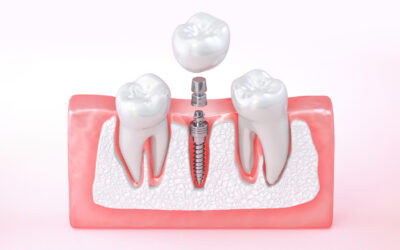What to Know About Jaw Bone Grafting for Dental Implants