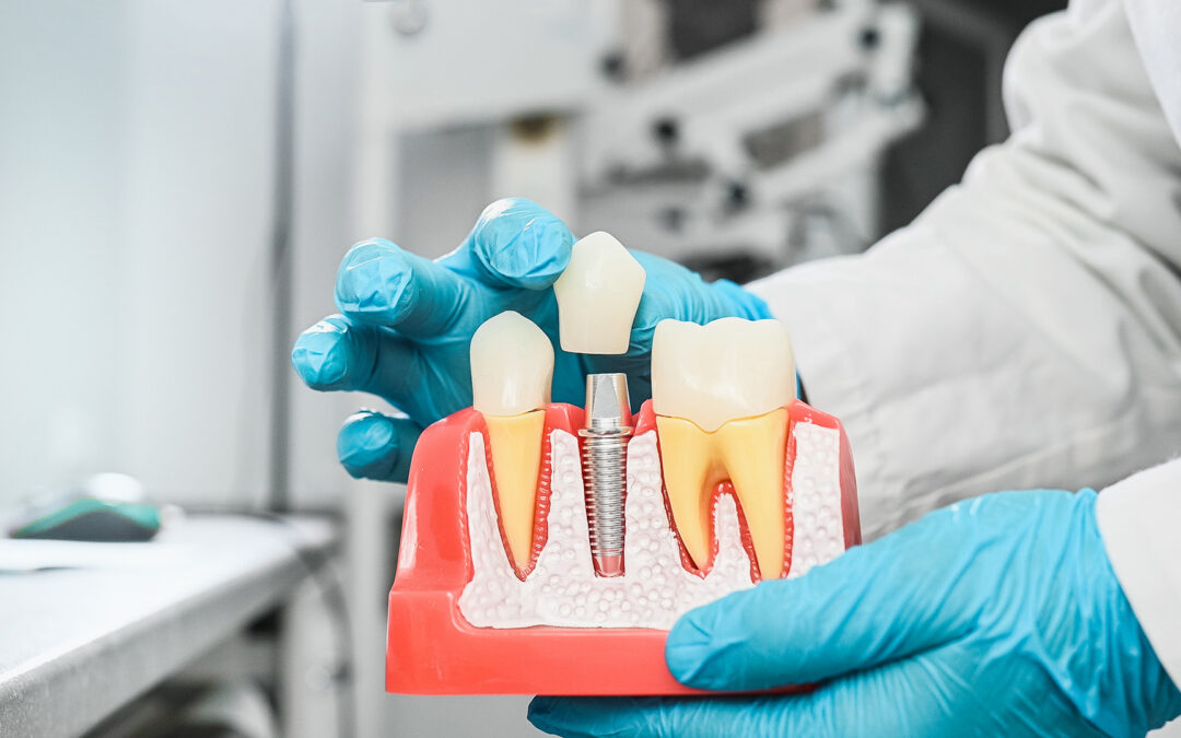Why Dental Implants Are Better Than Dentures