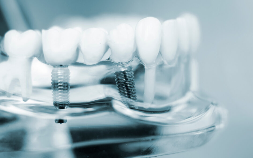 Common Problems With Dental Implants