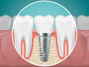 Common Problems With Dental Implants