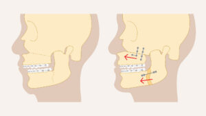 Orthognathic Surgery Expectations: What to Know Before and After Corrective Jaw Surgery