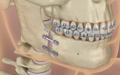 Orthognathic Surgery Expectations: What to Know Before and After Corrective Jaw Surgery