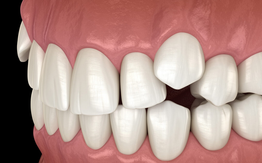 What Is an Impacted Canine