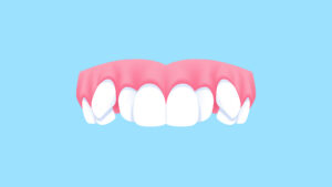 What Is an Impacted Canine?