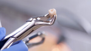 Multiple Dental Extractions at Once