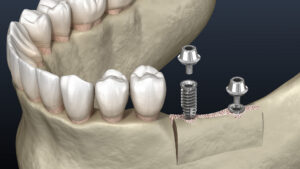How Ridge Augmentation Works