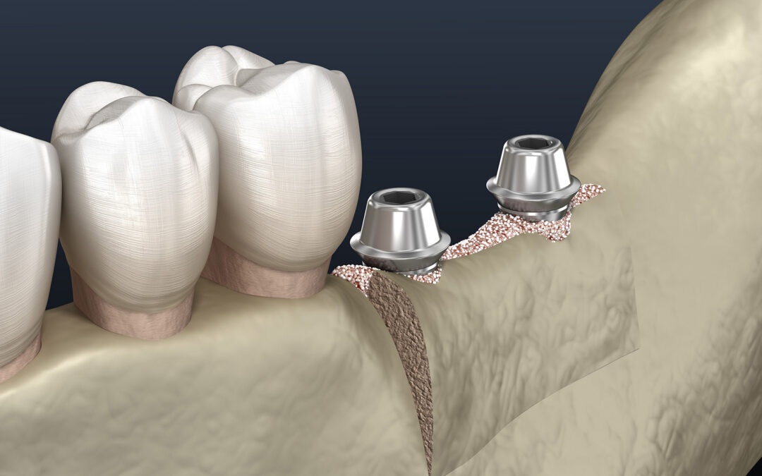 How Ridge Augmentation Works Guide