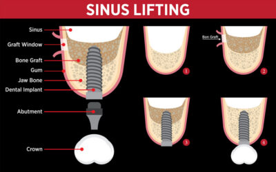 Sinus Lift: What It Is and Why You May Need It