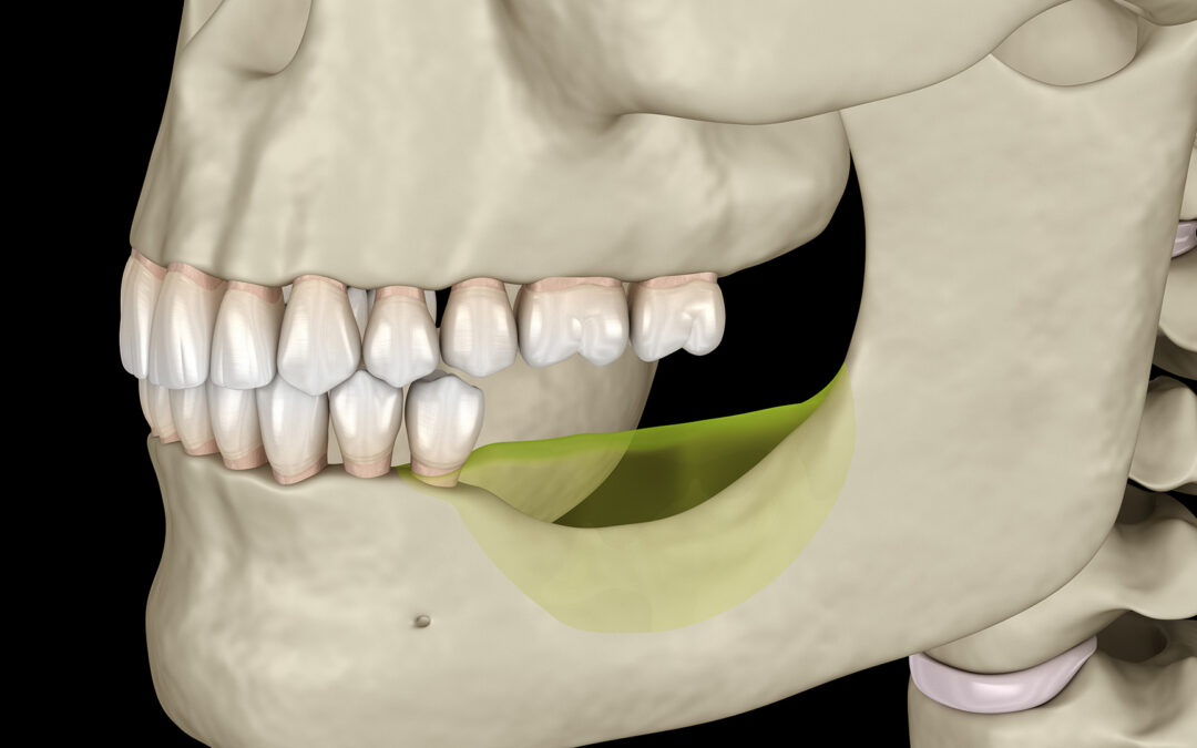 What to Know About Jaw Bone Loss and Deterioration