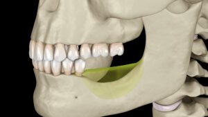 What to Know About Jaw Bone Loss and Deterioration