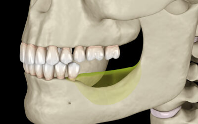 What to Know About Jaw Bone Loss and Deterioration